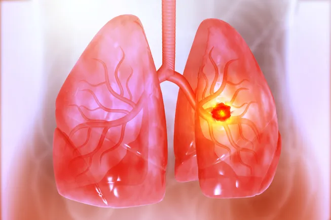 the-frontier-of-lung-cancer-breakthroughs-geographic-disparities-and-the-adc-revolution