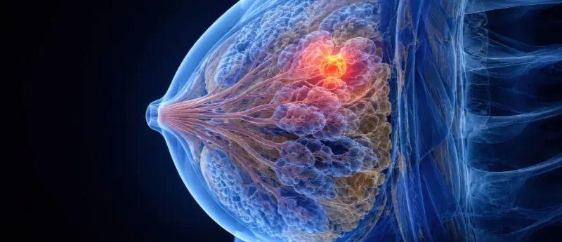addressing-the-evolution-of-malignancy-taylor-francis-launches-call-for-papers-on-breast-cancer-therapeutic-resistance