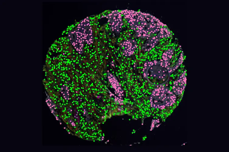 unlocking-the-biological-enigma-new-research-sheds-light-on-early-onset-colorectal-cancer
