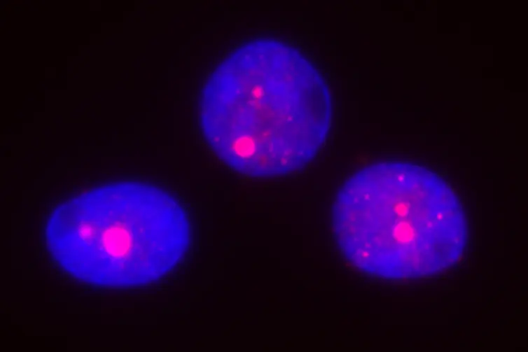 unlocking-the-genetic-clock-new-breakthroughs-in-huntingtons-disease-research