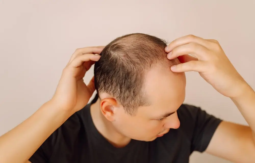 veradermics-groundbreaking-hair-loss-drug-shows-promising-phase-iii-results-poised-for-fda-approval